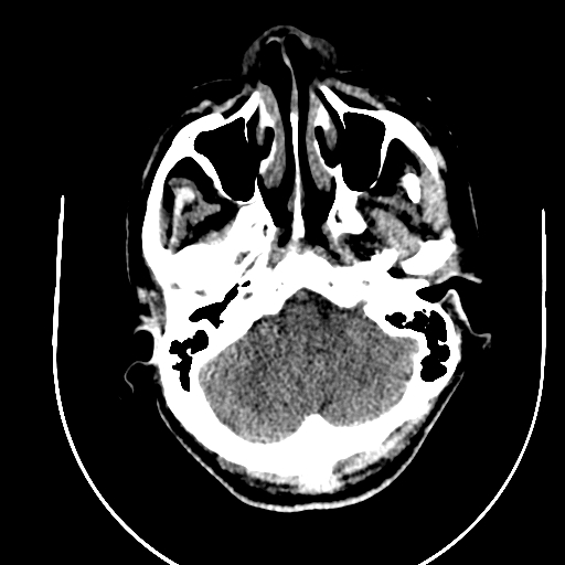 Chronic invasive fungal sinusitis (Radiopaedia 91563-109286 Axial non-contrast 10).jpg