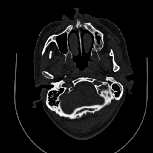 Chronic invasive fungal sinusitis (Radiopaedia 91563-109286 Axial sinus 4).jpg
