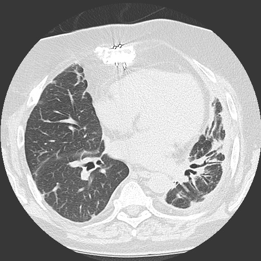 File:Chronic lung allograft dysfunction - restrictive form (Radiopaedia 60595-68316 Axial lung window 40).jpg