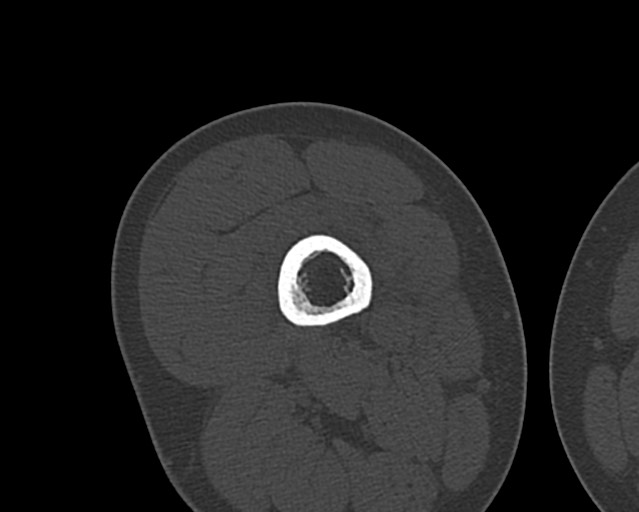 File:Chronic ostemyelitis of the femur with long sinus tract (Radiopaedia 74947-85982 Axial bone window 107).jpg