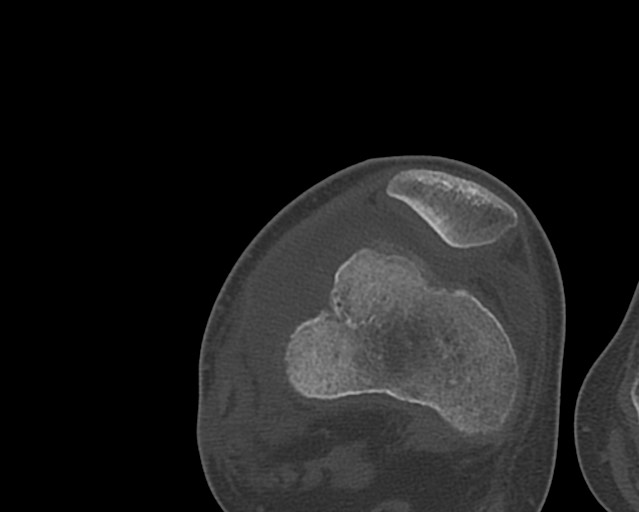 Chronic ostemyelitis of the femur with long sinus tract (Radiopaedia 74947-85982 Axial bone window 209).jpg