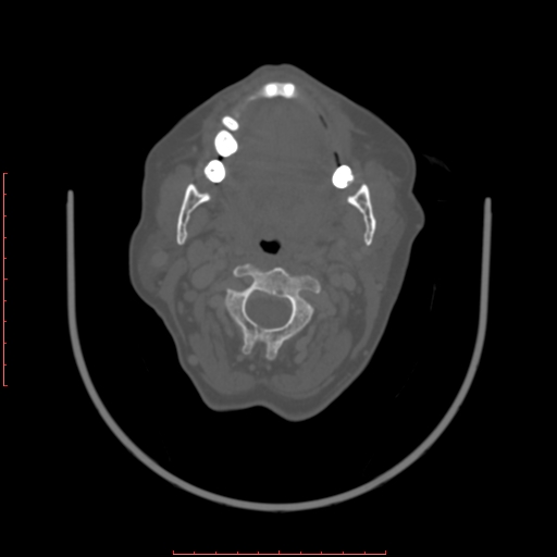 Chronic osteomyelitis - maxilla (Radiopaedia 23783-23927 Axial bone window 60).jpg