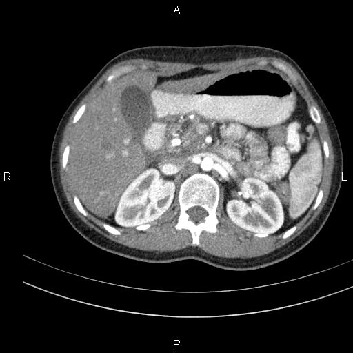 File:Chronic pancreatitis (Radiopaedia 64576-73450 B 48).jpg