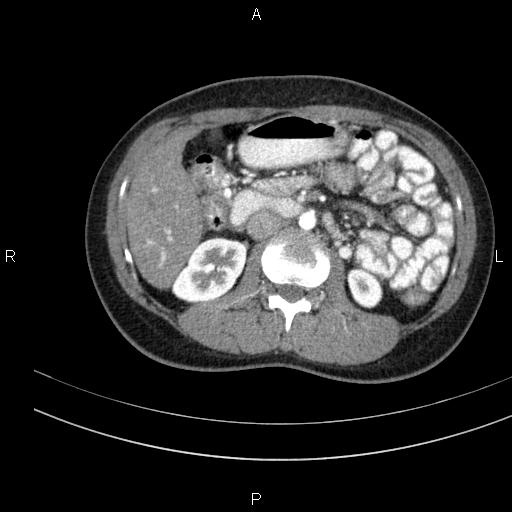 File:Chronic pancreatitis (Radiopaedia 64576-73450 B 71).jpg