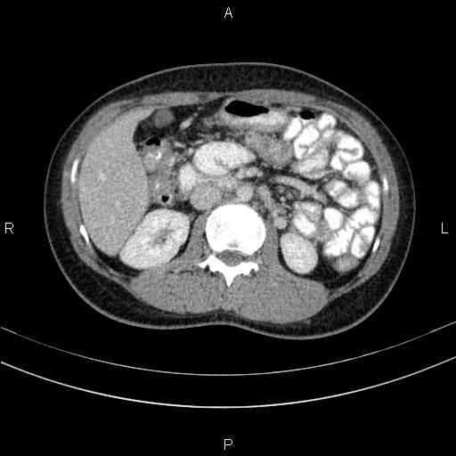 Chronic pancreatitis (Radiopaedia 64576-73450 C 71).jpg