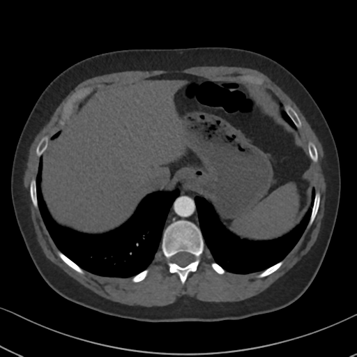 Chronic pulmonary embolus (Radiopaedia 39129-41341 Axial C+ CTPA 88).png