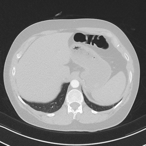 Chronic pulmonary embolus (Radiopaedia 39129-41341 Axial lung window 56).png