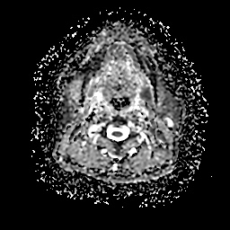 File:Chronic submandibular sialadenitis (Radiopaedia 61852-69885 Axial ADC 13).jpg