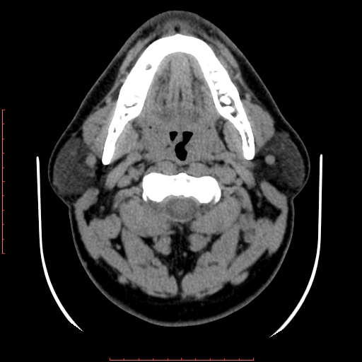 Chronic submandibular sialolithiasis (Radiopaedia 69817-79814 Axial non-contrast 83).jpg