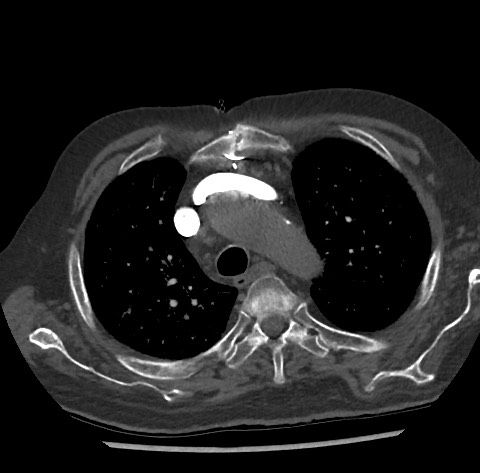 Chronic thromboembolic pulmonary disease (Radiopaedia 90694-108119 Axial C+ CTPA 26).jpg