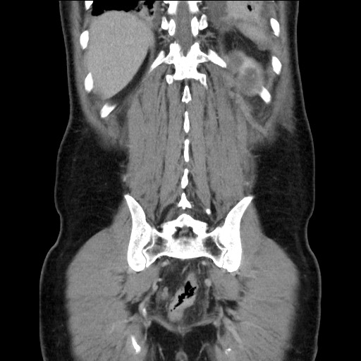 File:Chronic ureteropelvic junction obstruction (Radiopaedia 78365-90996 B 82).jpg