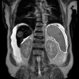 File:Cirrhosis and hepatocellular carcinoma in the setting of hemochromatosis (Radiopaedia 75394-86594 Coronal T2 21).jpg