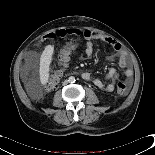 File:Cirrhosis and hepatocellular carcinoma in the setting of hemochromatosis (Radiopaedia 75394-86595 B 50).jpg