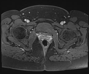 File:Class II Mullerian duct anomaly- unicornuate uterus with rudimentary horn and non-communicating cavity (Radiopaedia 39441-41755 Axial T1 fat sat 110).jpg
