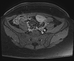 File:Class II Mullerian duct anomaly- unicornuate uterus with rudimentary horn and non-communicating cavity (Radiopaedia 39441-41755 Axial T1 fat sat 6).jpg