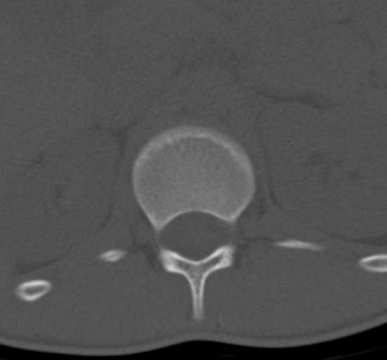 Clear cell meningoma - lumbar spine (Radiopaedia 60116-67691 Axial bone window 6).png