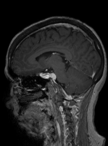 Clival meningioma (Radiopaedia 53278-59248 Sagittal T1 C+ 274).jpg