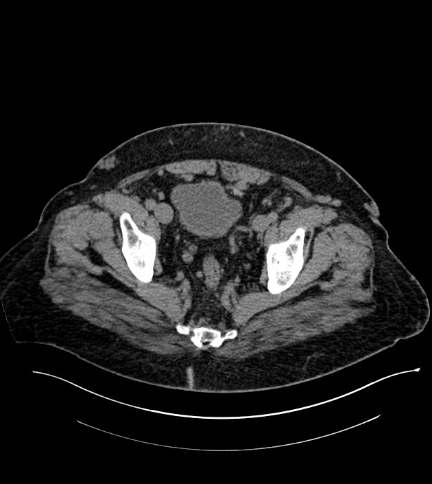 Closed-loop small bowel obstruction-internal hernia (Radiopaedia 78439-91096 Axial non-contrast 137).jpg