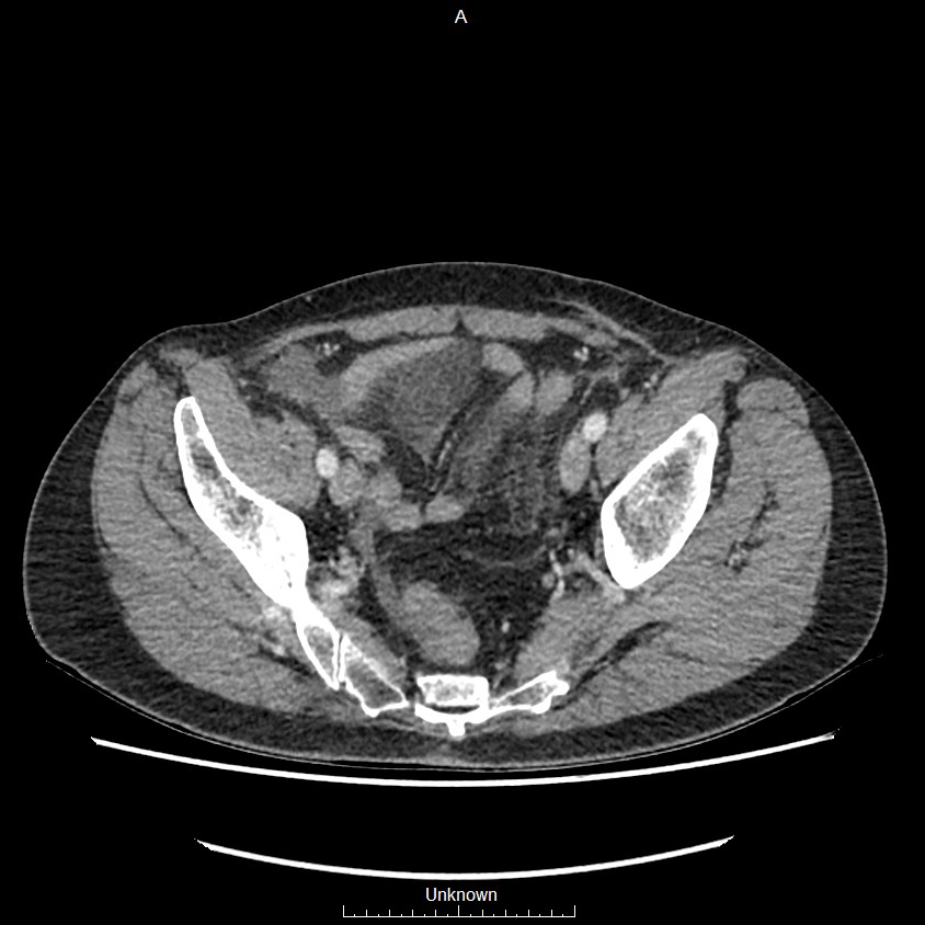 Closed loop bowel obstruction and ischemia (Radiopaedia 86959-103180 A 74).jpg
