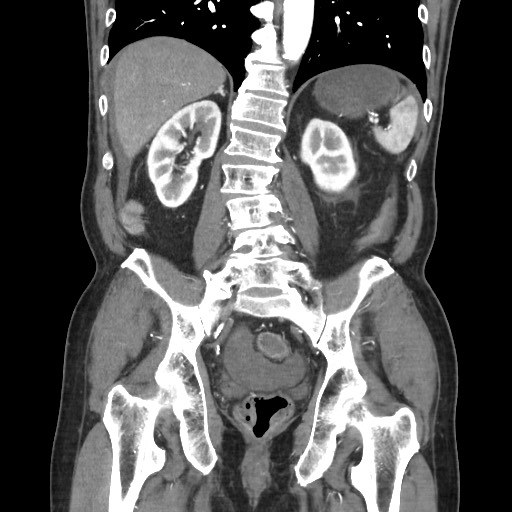 File:Closed loop obstruction due to adhesive band, resulting in small bowel ischemia and resection (Radiopaedia 83835-99023 C 85).jpg