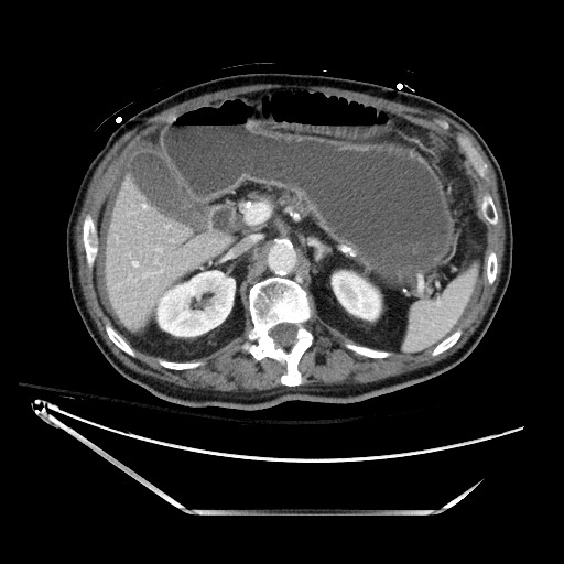 File:Closed loop obstruction due to adhesive band, resulting in small bowel ischemia and resection (Radiopaedia 83835-99023 D 50).jpg