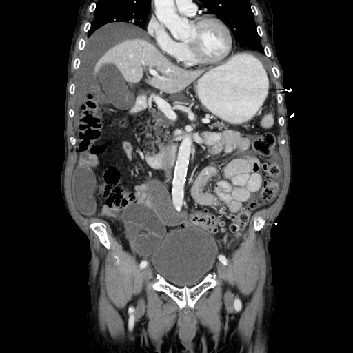 File:Closed loop small bowel obstruction - adhesive disease and hemorrhagic ischemia (Radiopaedia 86831-102990 B 57).jpg