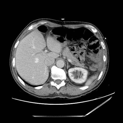Closed loop small bowel obstruction - omental adhesion causing "internal hernia" (Radiopaedia 85129-100682 A 34).jpg