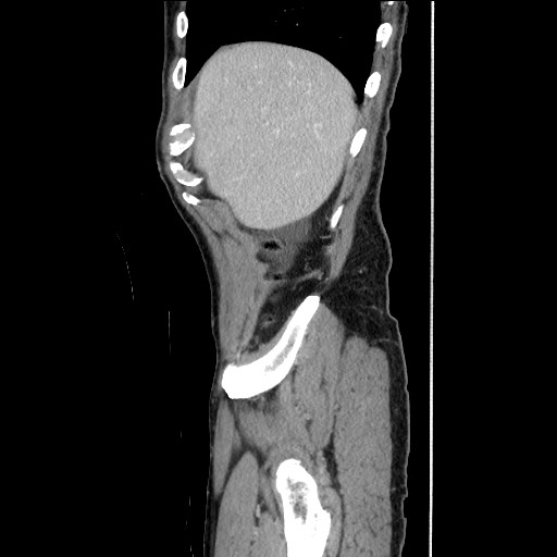 Closed loop small bowel obstruction - omental adhesion causing "internal hernia" (Radiopaedia 85129-100682 C 38).jpg