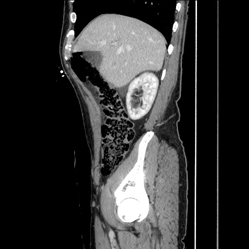 File:Closed loop small bowel obstruction - omental adhesion causing "internal hernia" (Radiopaedia 85129-100682 C 53).jpg