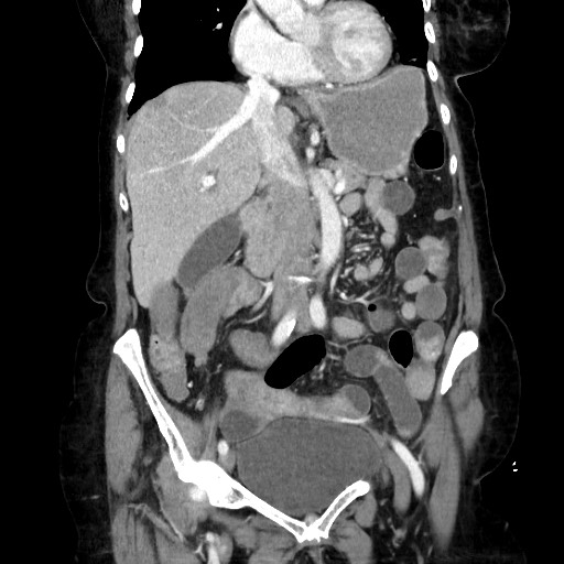 Closed loop small bowel obstruction due to adhesive band, with intramural hemorrhage and ischemia (Radiopaedia 83831-99017 C 56).jpg