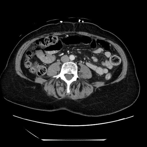 Closed loop small bowel obstruction due to adhesive bands - early and late images (Radiopaedia 83830-99014 A 82).jpg