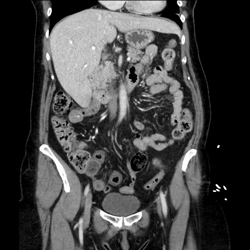 Closed loop small bowel obstruction due to adhesive bands - early and late images (Radiopaedia 83830-99014 B 54).jpg