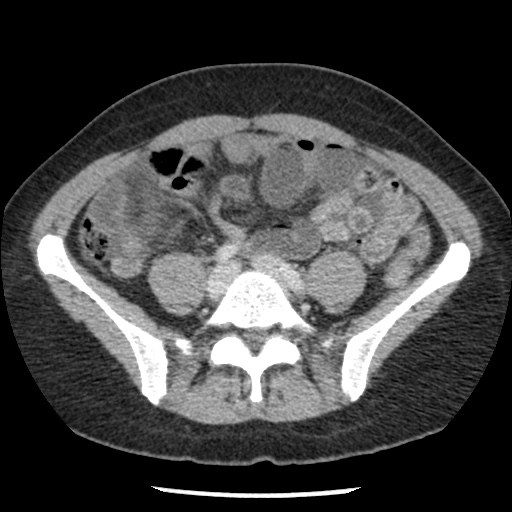 File:Closed loop small bowel obstruction due to trans-omental herniation (Radiopaedia 35593-37109 A 58).jpg