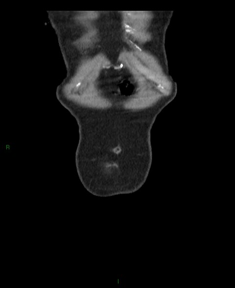 Closed loop small bowel obstruction with ischemia (Radiopaedia 84180-99456 B 66).jpg