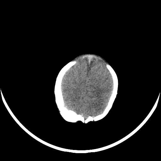 File:Cloverleaf shaped skull in the absence of craniosynostosis (Radiopaedia 21296-21216 Axial non-contrast 17).jpg