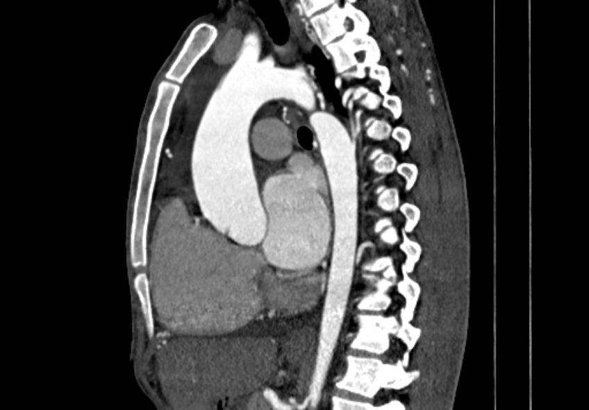 Coarctation of aorta with aortic valve stenosis (Radiopaedia 70463-80574 B 70).jpg