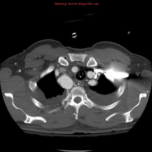 File:Coarctation of the aorta (Radiopaedia 8681-9490 B 14).jpg