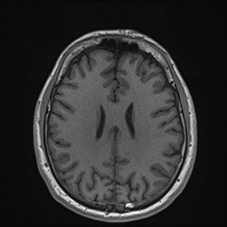 File:Cochlear incomplete partition type III associated with hypothalamic hamartoma (Radiopaedia 88756-105498 Axial T1 128).jpg