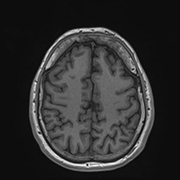 Cochlear incomplete partition type III associated with hypothalamic hamartoma (Radiopaedia 88756-105498 Axial T1 145).jpg
