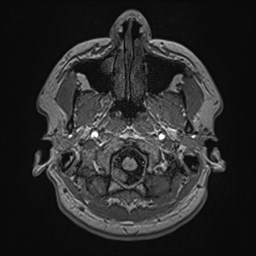File:Cochlear incomplete partition type III associated with hypothalamic hamartoma (Radiopaedia 88756-105498 Axial T1 33).jpg