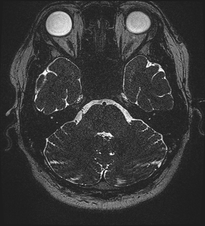 Cochlear incomplete partition type III associated with hypothalamic hamartoma (Radiopaedia 88756-105498 Axial T2 88).jpg