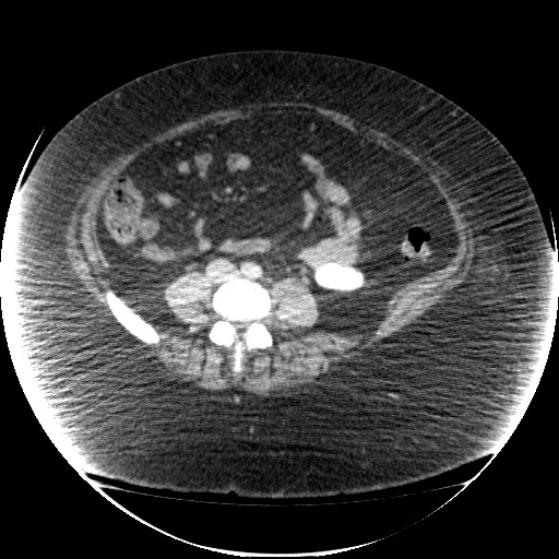 File:Collection due to leak after sleeve gastrectomy (Radiopaedia 55504-61972 A 52).jpg