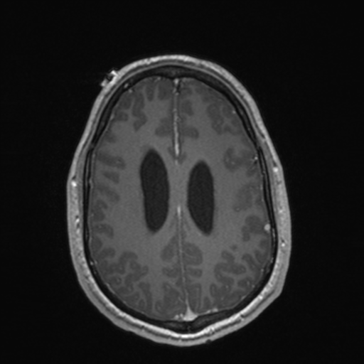 File:Colloid cyst (Radiopaedia 44510-48181 Axial T1 C+ 132).png