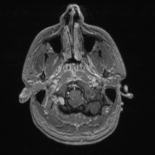 File:Colloid cyst (Radiopaedia 44510-48181 Axial T1 C+ 30).png