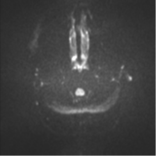 Colloid cyst (Radiopaedia 53164-59125 Axial DWI 29).png