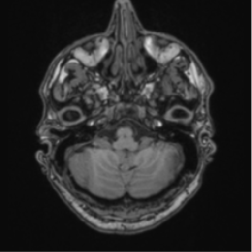 File:Colloid cyst of the third ventricle (Radiopaedia 86571-102662 Axial T1 18).png