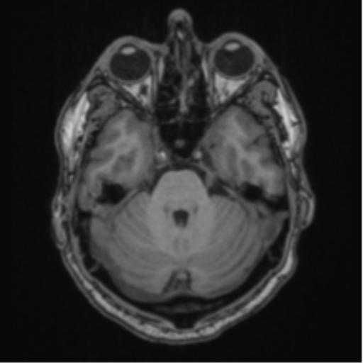 File:Colloid cyst of the third ventricle (Radiopaedia 86571-102662 Axial T1 25).png