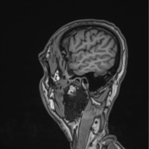 File:Colloid cyst of the third ventricle (Radiopaedia 86571-102662 Sagittal T1 12).png