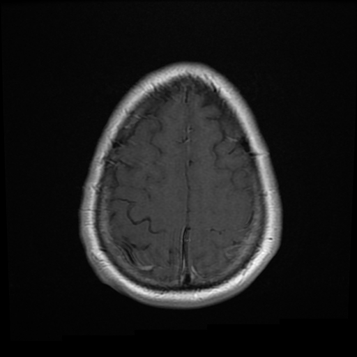 File:Colloid cyst with anterior communicating artery aneurysm (Radiopaedia 33901-35091 Axial T1 C+ 24).jpg