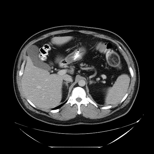 Colocolic intussusception due to lipoma (Radiopaedia 73712-84508 A 32).jpg